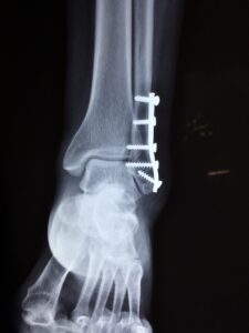 Ankle in pain x-ray