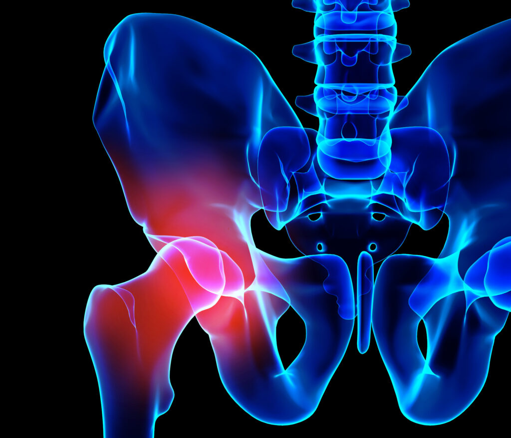 Radiographie du squelette douloureux de la hanche, illustration 3D.